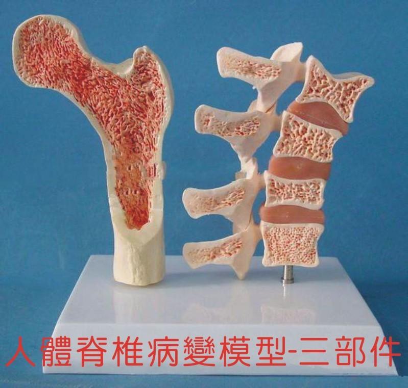 【福滿來】人體脊椎病變模型 腰椎骨質疏鬆病變椎間盤 三節腰椎組合模型 醫學教學模型ARIO