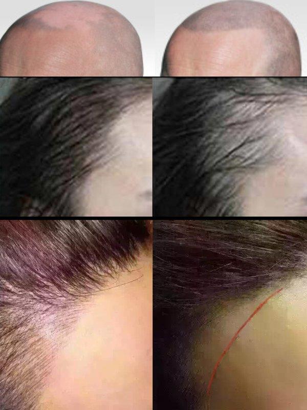 髮量稀疏另類禿頭救星刺青障眼「髮」前5名5折優--數量有限 要來要快喔--擬真繡髮 紋髮際線 頭皮紋身 頭毛刺青刷卡分期