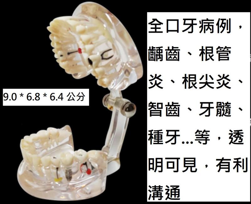 牙齒模型 透明成人綜合口腔病理模型 牙周病齲齒演示模型