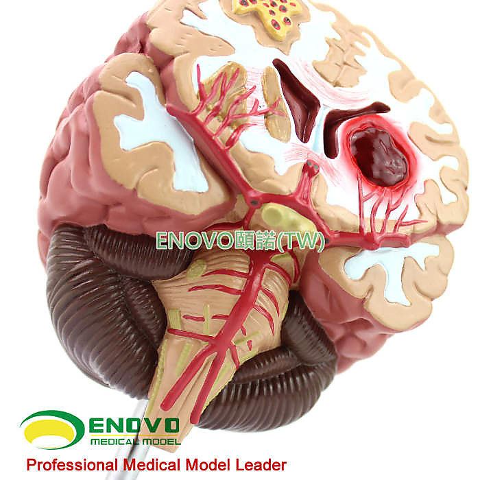 (ENOVO-286) 醫學人體腦部疾病模型 大腦模型神經內外科腦中風腦溢血 