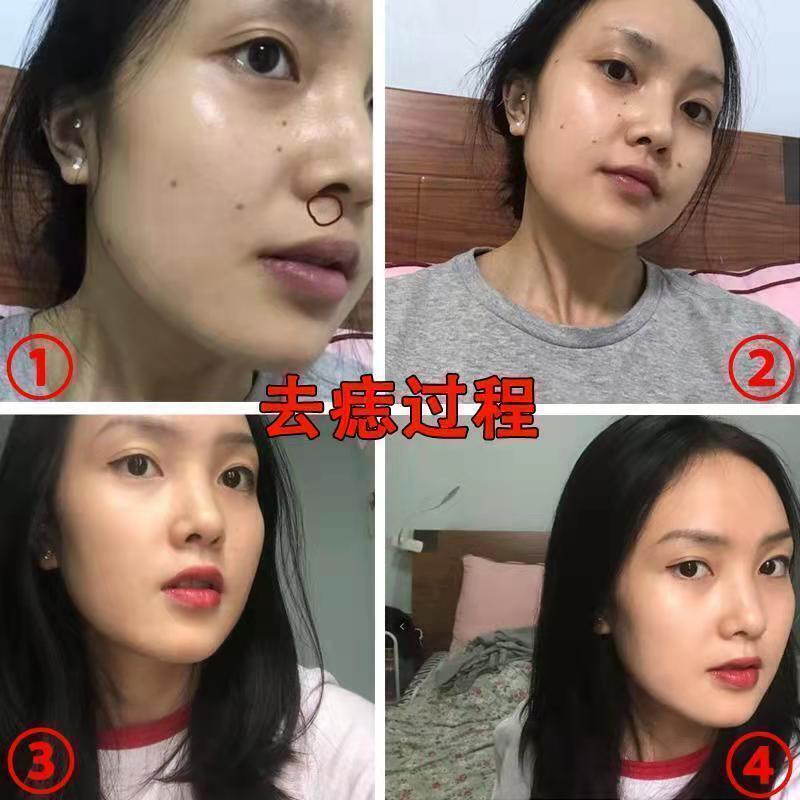 點痣藥水無痕臉部無痕去痣神器去臉部黑痣痦子雀斑取痣點志點痣膏 露天市集 全臺最大的網路購物市集 | 露天市集 | 全台最大的網路購物市集