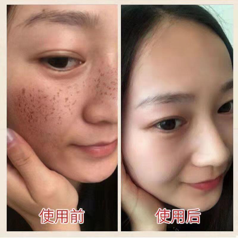 點痣藥水無痕臉部無痕去痣神器去臉部黑痣痦子雀斑取痣點志點痣膏 露天市集 全臺最大的網路購物市集 | 露天市集 | 全台最大的網路購物市集